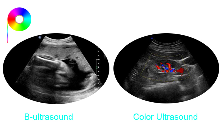 b-ultrasound and color ultrasound